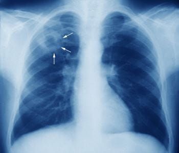 Científicas cordobesas desarrollan una fórmula pediátrica contra la tuberculosis