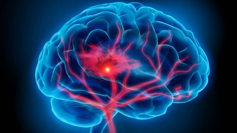 Se celebra el Día Mundial de la Lucha contra el Accidente Cerebrovascular (ACV)